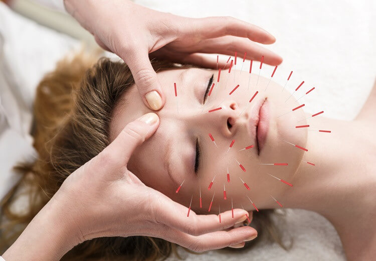 Acupuncture : une alternative naturelle contre l'acné - Heyme