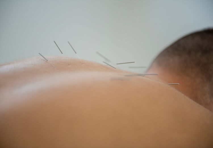 L’acupuncture : quel remboursement ? - Heyme
